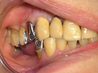 歯の欠損