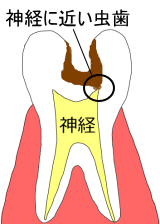 深い虫歯
