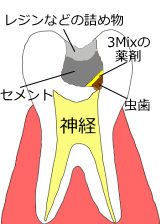 3Mix法で治療