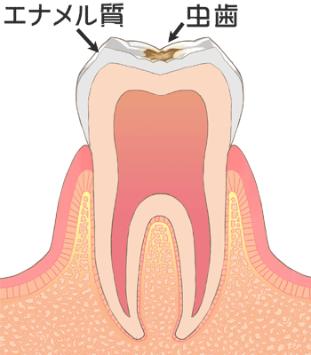 初期の虫歯