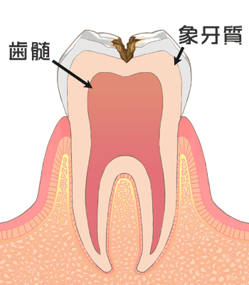 少し進んだ虫歯