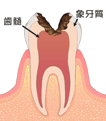 神経まで進んだ虫歯