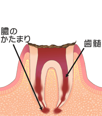 歯冠部が崩壊した虫歯