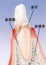 初期の歯周病、はぐきが一部赤くぶよぶよ
