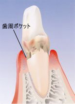 中等度の歯周病、歯周ポケットができて骨が溶け始める