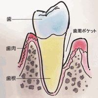 歯周ポケット