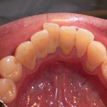 歯石のついた歯の画像