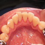 歯石をとった後の歯の画像