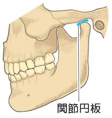 関節円盤