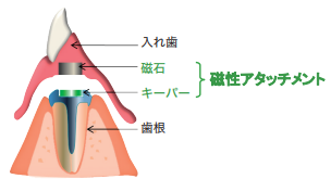 磁石式入れ歯