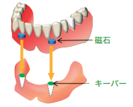 磁石式入れ歯